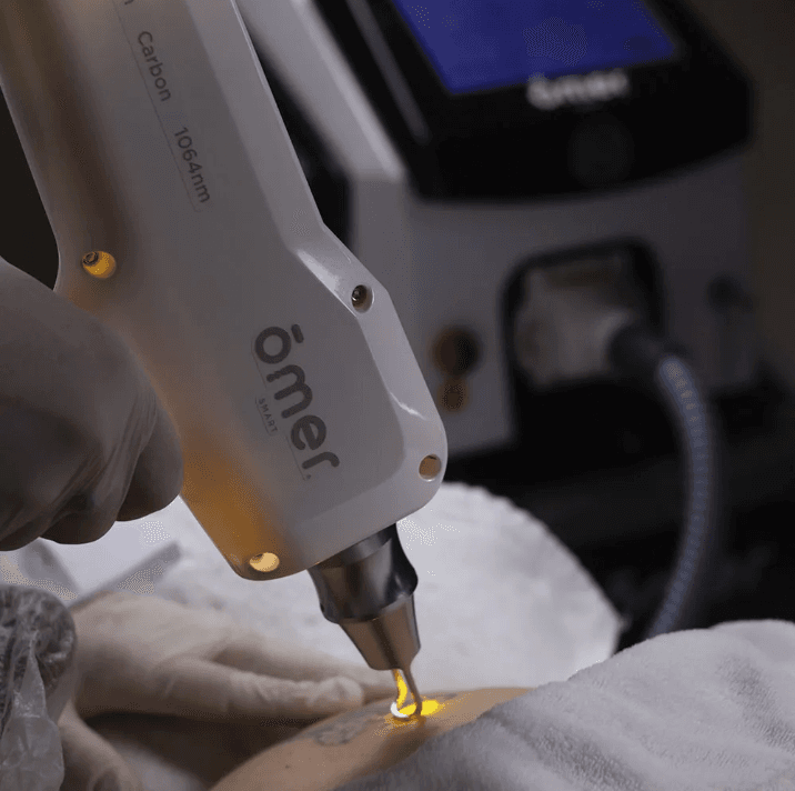 Disparo de laser Q-Switched em sessão de despigmentação